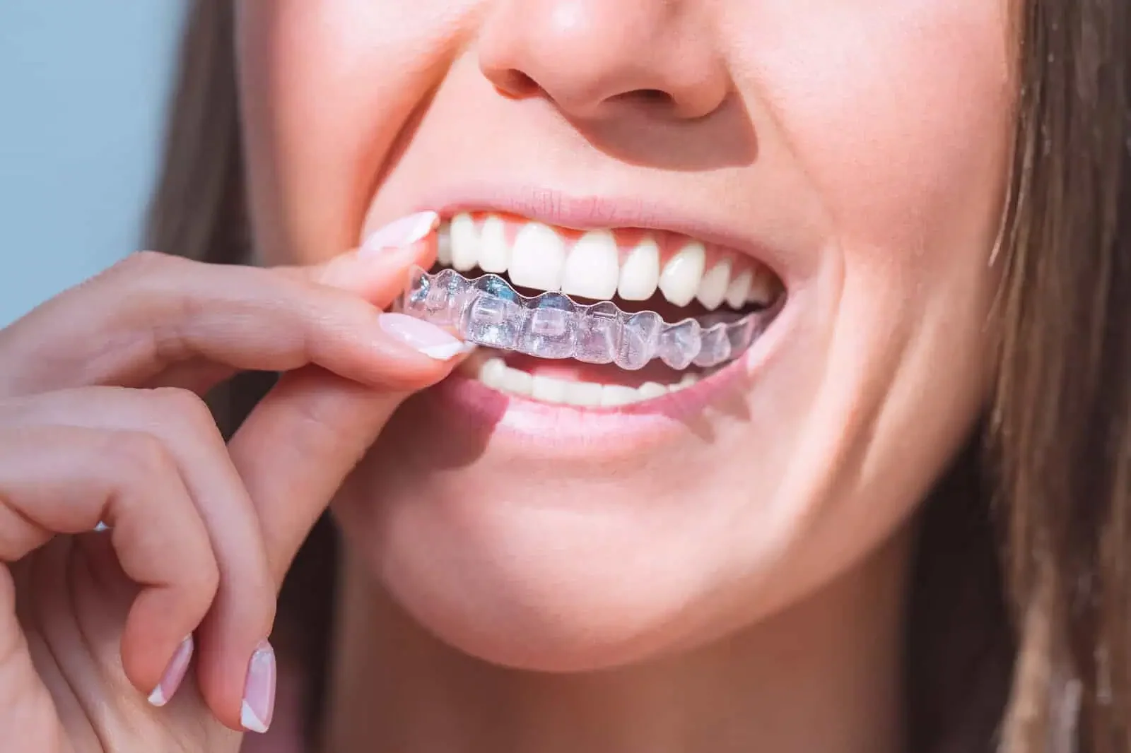 Clear aligner treatment at Refined Smiles