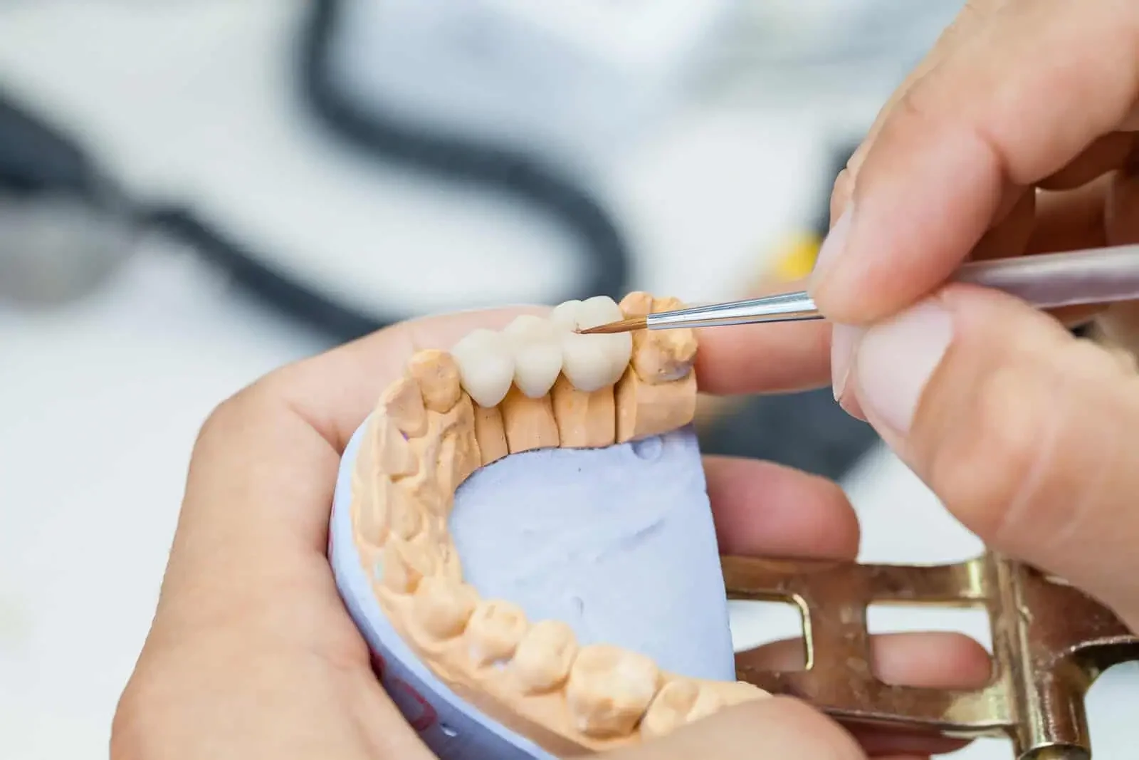 Crown Lengthening at Refined Smiles