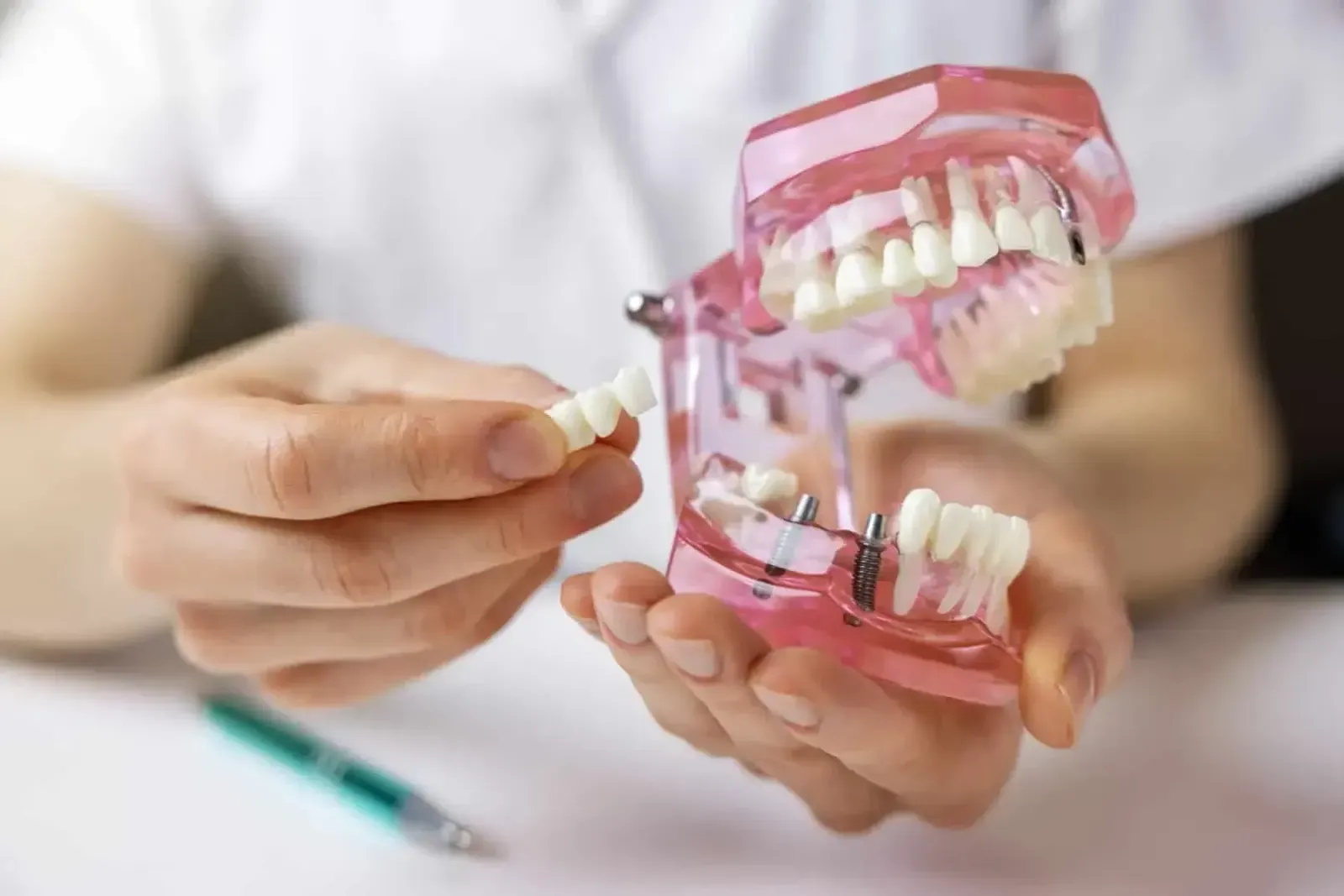 Bridges at Refined Smiles
