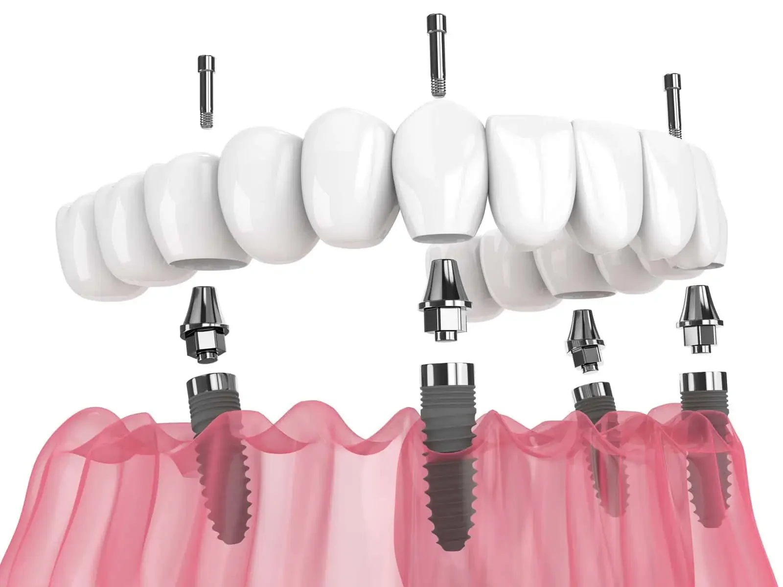 Full-Arch Replacement at Refined Smiles