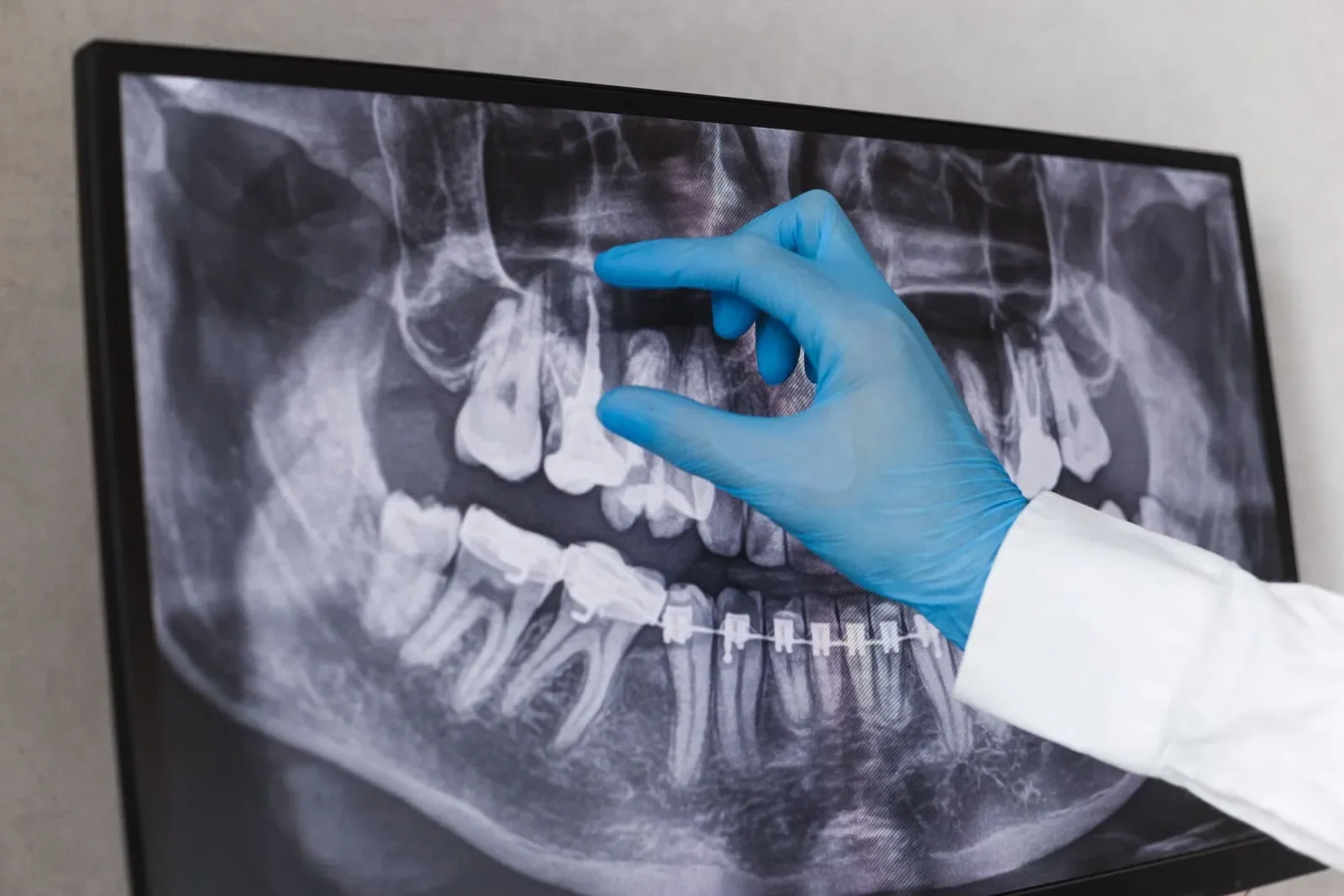 Root Canal Therapy at Refined Smiles